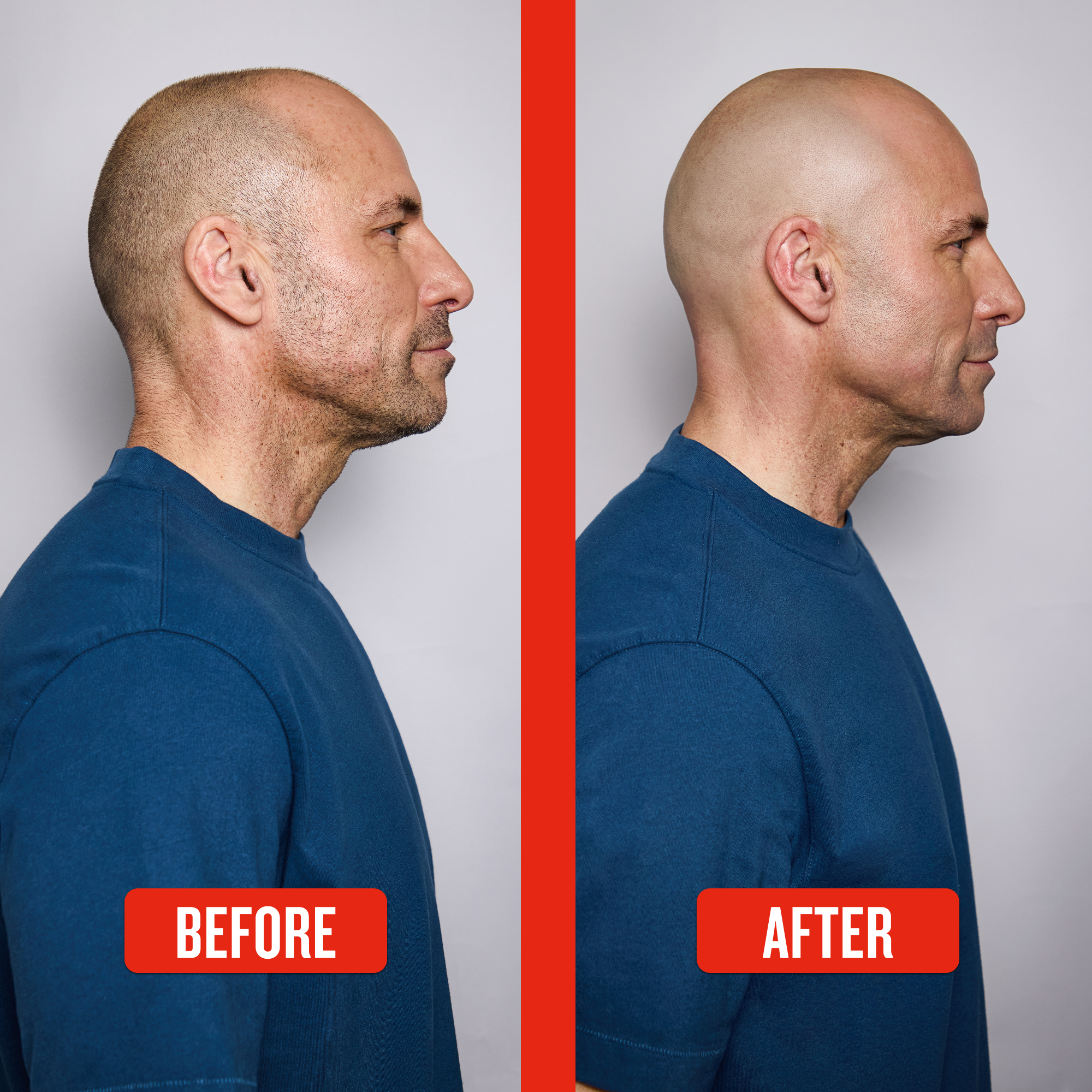 Before and after comparison of a man with shaved sides and a full head of hair.