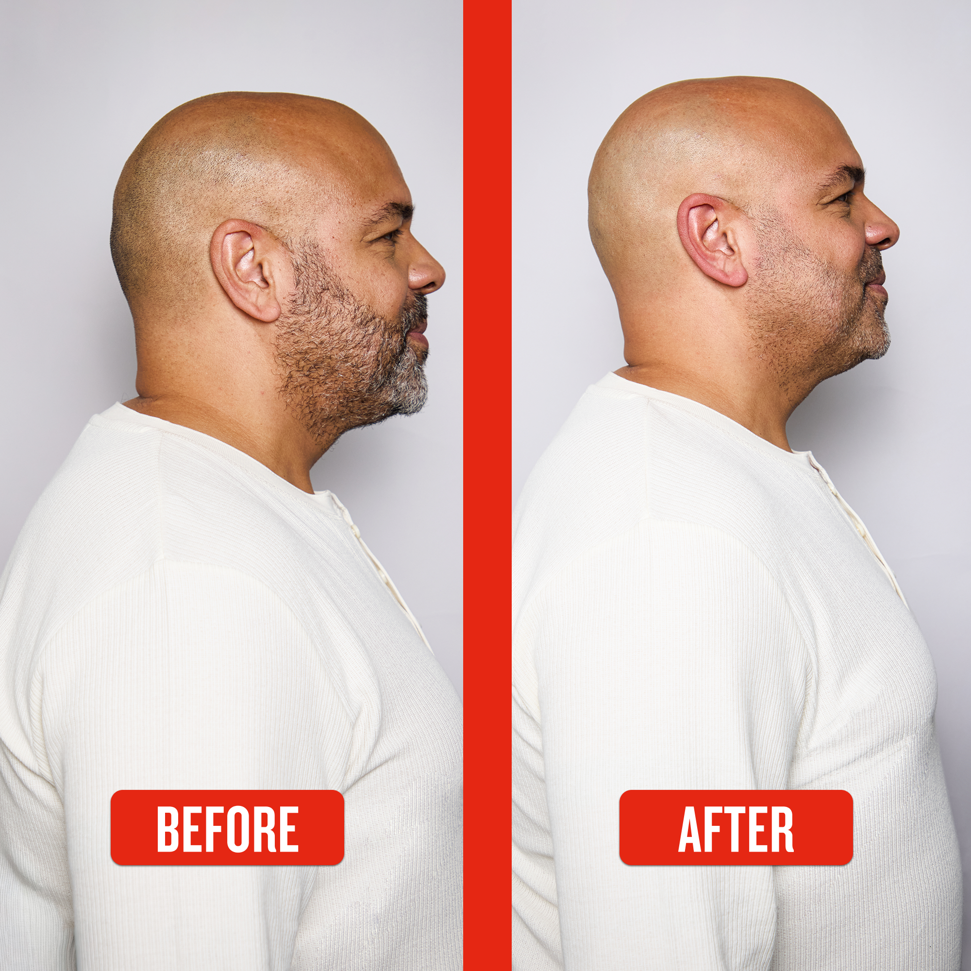 Side-by-side comparison of a man's profile labeled 'Before' and 'After' on a white background.